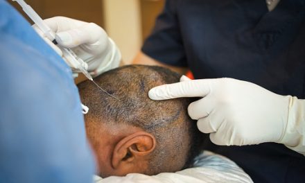 Anthony Constantinou Share Important Facts about Hair Transplant