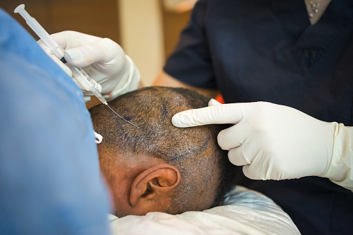 Anthony Constantinou Share Important Facts about Hair Transplant