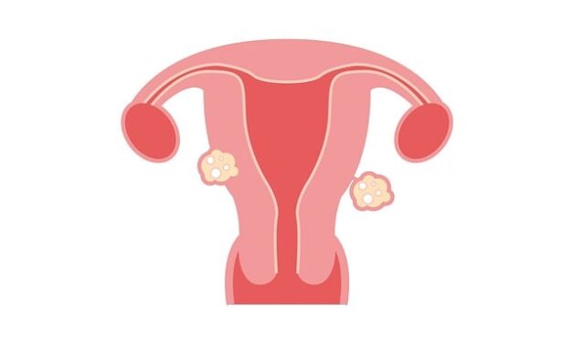 Fibroids Awareness Month 2025: Understanding, Empowering, and Supporting Women’s Health